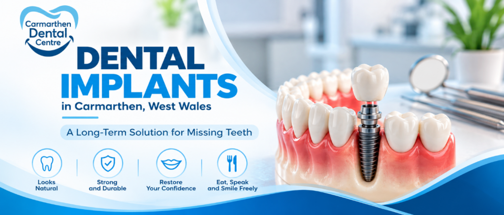 Dental Implants in Carmarthen, West Wales: A Long-Term Solution for Missing Teeth
